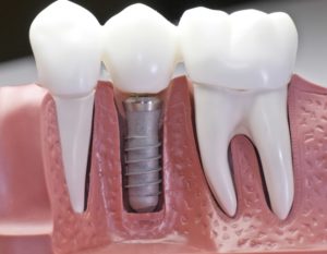 Dental Bridge Procedure | Replace Missing Teeth Warrensburg MO | Oak Grove | Windsor